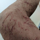Wolpin’s leg post-Barkley